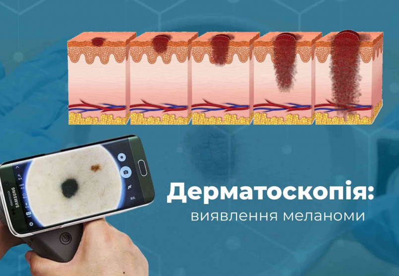 Меланома: як виявити рак шкіри на ранній стадії?